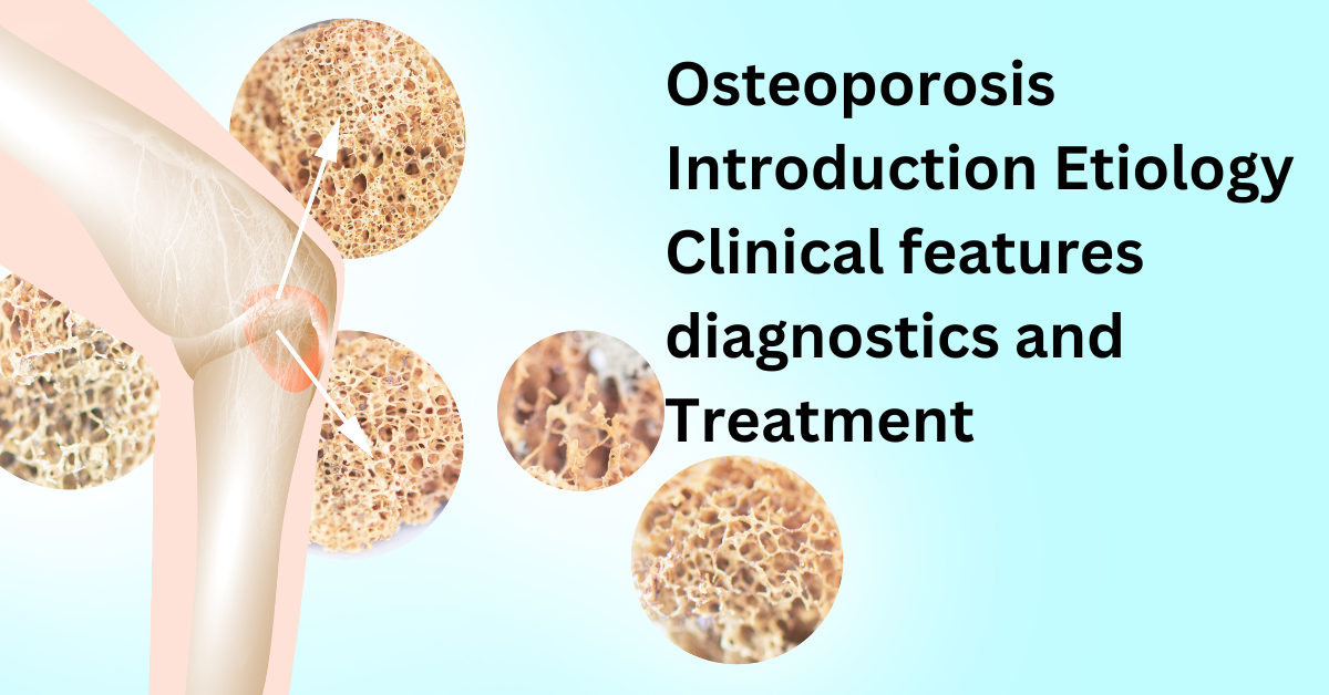 osteoporosis introduction for assignment